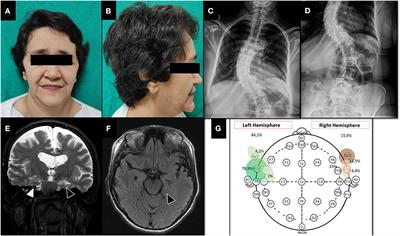 Case report: Successful anterior temporal lobectomy in drug-resistant temporal lobe epilepsy associated with Sotos syndrome